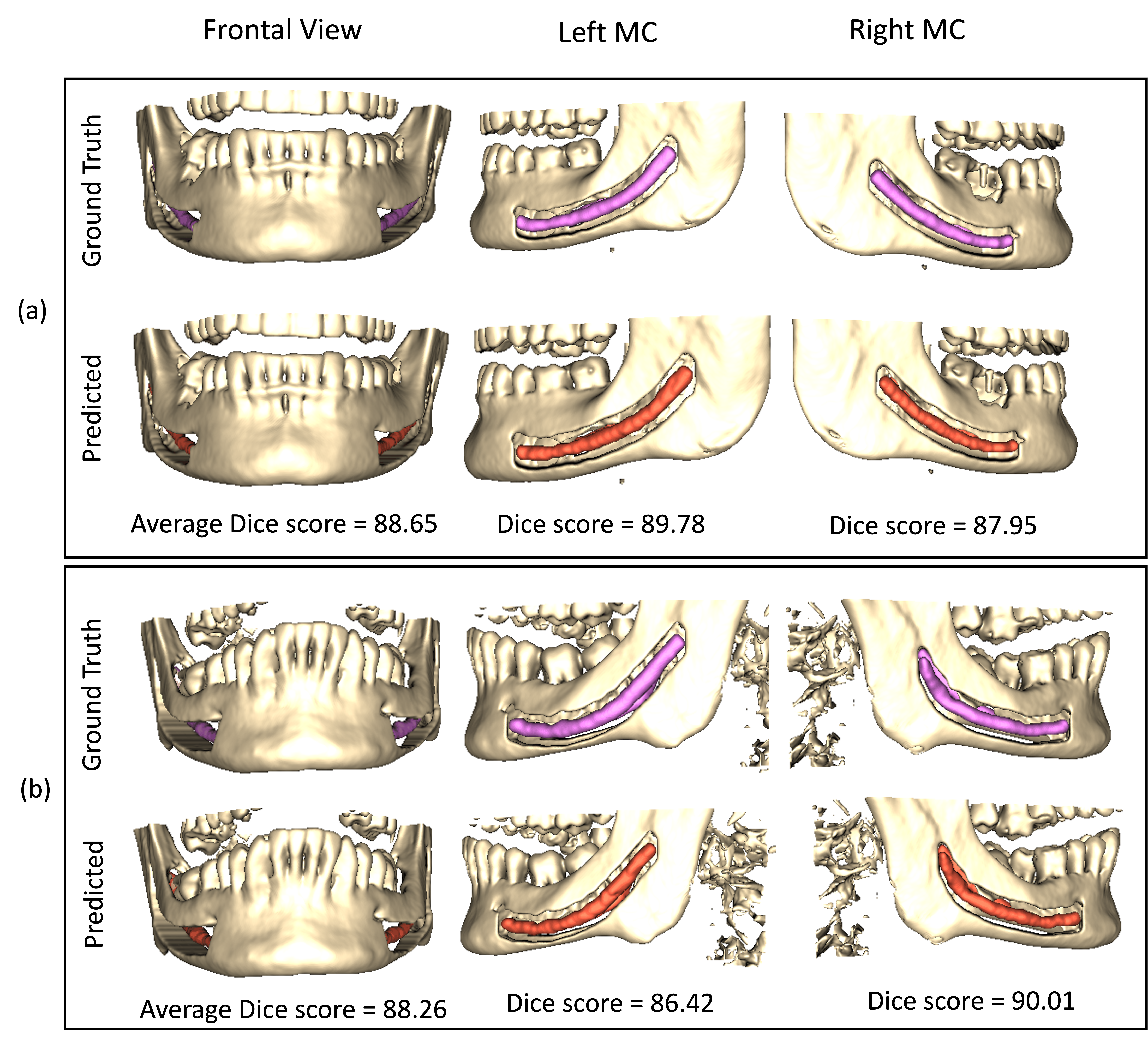 Mandibular Canal Segmentation